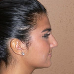 Rhinoplasty - Before And After Pictueres