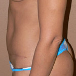 Tummy Tuck - Before And After Pictueres