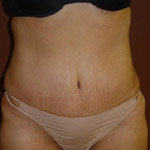 Tummy Tuck - Before And After Pictueres
