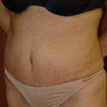 Tummy Tuck - Before And After Pictueres