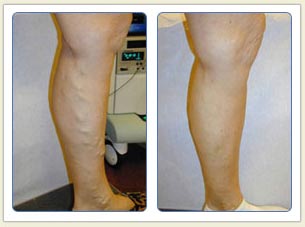 Varicose veins and broken vessels removal