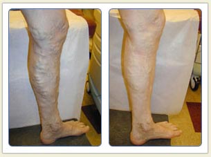 Varicose veins and broken vessels removal