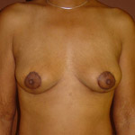 Vertical Mastopexy - Before And After Pictueres